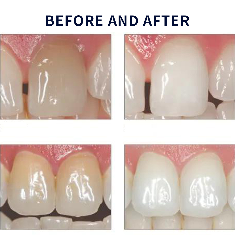 20% pF 20 16ชุดเจล8x1.2มล. ชุด - Teeth Whitening Clinic บทวิจารณ์และราคา