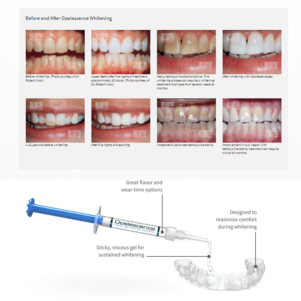 20% pF 20 16ชุดเจล8x1.2มล. ชุด - Teeth Whitening Clinic บทวิจารณ์และราคา